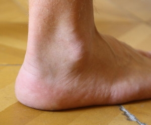 Achilles Tendon Injuries