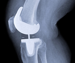 Building a Better Knee