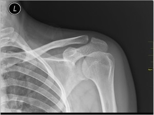 Frozen Shoulder in Diabetics