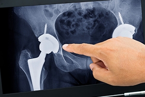 What Treatments Does a Hip Surgeon in Spokane Offer?